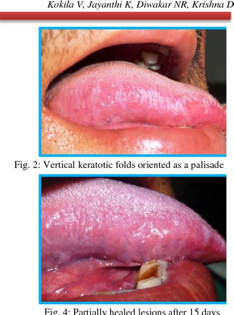 Figure 1 From Hiv Induced Oral Hairy Leukoplakia A Case Report