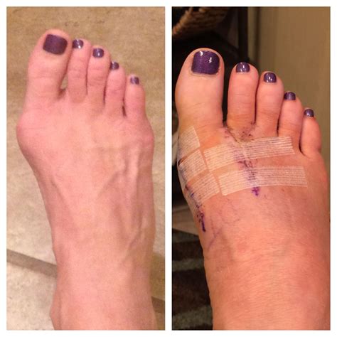 Before And After Tight Rope Surgery To Repair Bunion Bunion Rope