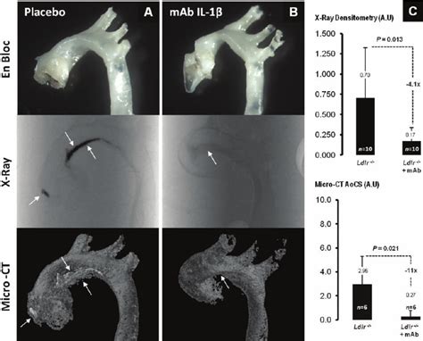 Significant Reduction Of Aortic Calcification In Il 1 B Mab Treated