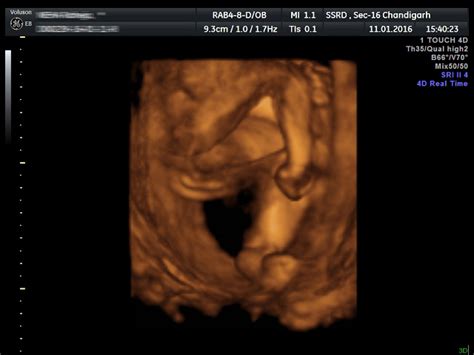 Clubfoot, or talipes equinovarus, is a deformity in which the foot is excessively plantar flexed, with ultrasound. SSRD - Interesting Cases - Fetal Clubfoot - Ultrasound ...