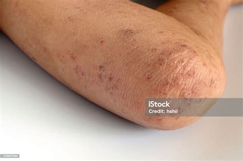 Eczema Stock Photo Download Image Now 2015 Allergy Close Up Istock