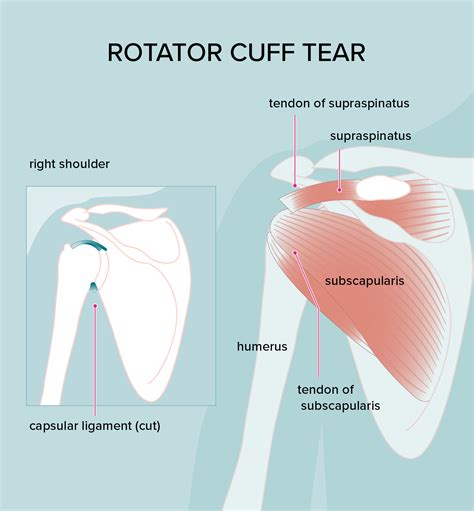 Rotator Cuff Injury Treatments Symptoms And Diagnosis Subscapularis