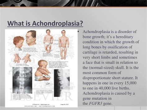Ppt Achondroplasia By Justin Baker Powerpoint Presentation Free