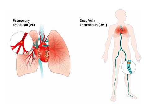 Novas Orientações sobre Embolia Pulmonar Portal Cirurgia Vascular