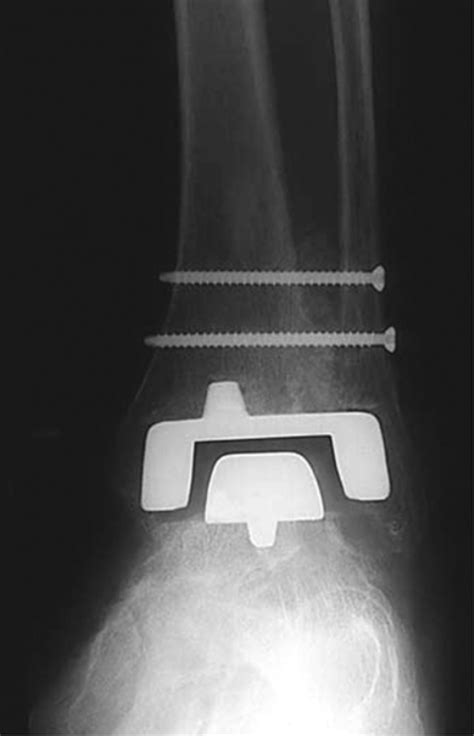 Ankle Replacement Bone And Joint