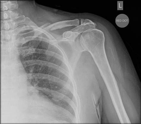 Pathological Clavicle Fracture Radiology Case
