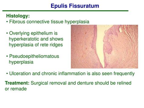 Ppt Soft Tissue Tumors Powerpoint Presentation Free Download Id300284