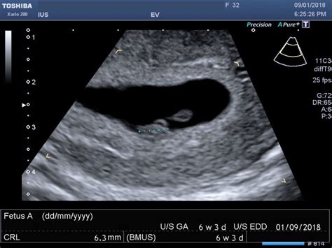 6 Week Pregnancy Scan 6 Week Ultrasound 6 Week Scan 6 Week Scan Photo International