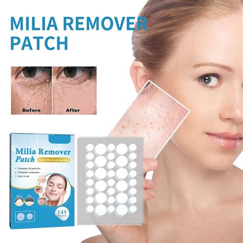 144pcs Milia Remover Patches For Milia Spot Treatment Soften Skin