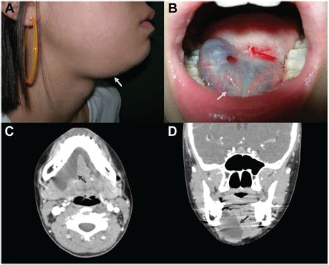 Transoral Complete Vs Partial Excision Of The Sublingual Gland For