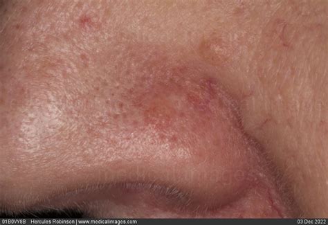 Early Stages Of Skin Cancer On Face