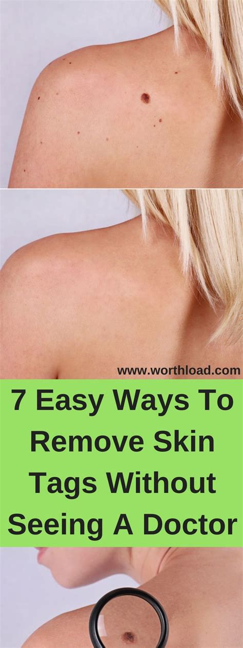 7 Easy Ways To Remove Skin Tags Without Seeing A Doctor Skin Tag