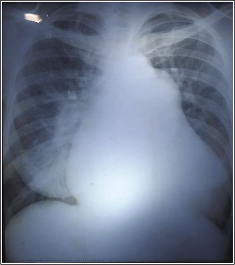 Chest X Ray Showing Cardiomegaly Prominent Pulmonary Conus And Upper