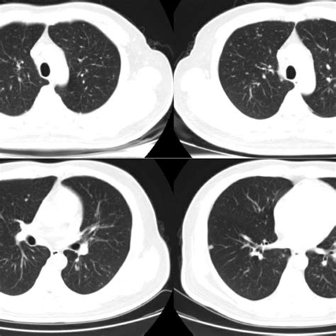 Presentation Of Chest Ct Scan Chest Scan Showed Diffuse Small