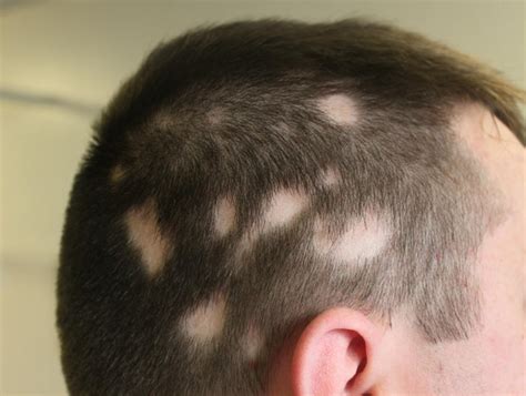 A new approach to the prevention and cosmetic treatment of alopecia aminexil. Hope for sufferers of Alopecia Areata