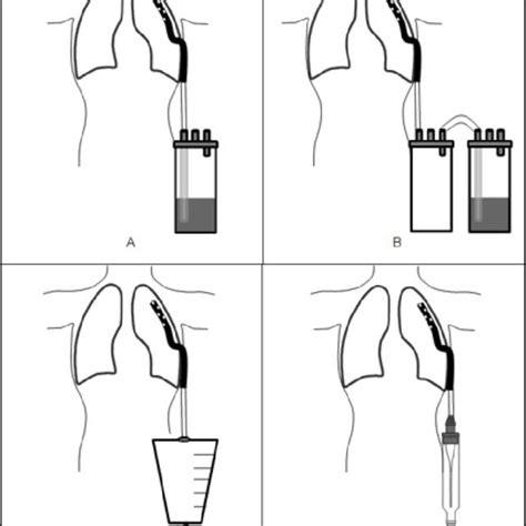 Closed Drainage System With A Pigtail Chest Tube A Pigtail Chest Tube