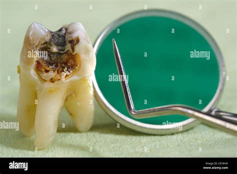 Extracted Tooth With Dental Caries Stock Photo Alamy