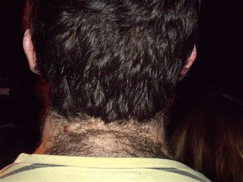 The neck hump area can be soft and not painful. Hairaway Canada www.hairawaycanada.ca: Neck hair and ...