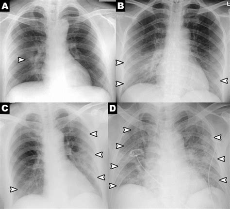 Check out our new ground glass appearance on cxr study sets and optimise your study time. Frequency and Distribution of Chest Radiographic Findings ...