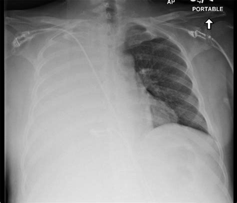 Wet, Wacky Lungs: A Quick Look At Pleural Effusions — NUEM ...