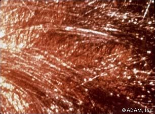 The New York Times > Health > Image > Head Louse ...