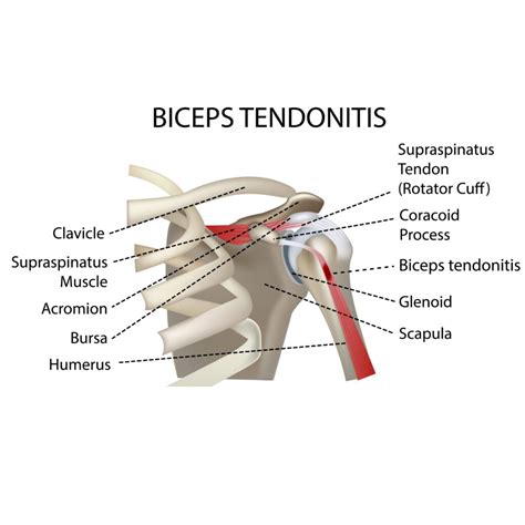 Biceps Tendonitis Motus Physical Therapy