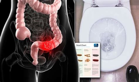 Most dogs in this state don't want to eat much and appetite stimulants (b complex, prednisolone, anabolic steroids, cyproheptadine) don't do much to help. Bowel cancer symptoms: Signs of a tumour include diarrhoea ...