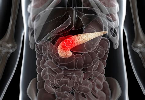 Pancreatic neuroendocrine tumors (nets), or islet if you have pancreatic cancer or are close to someone who does, knowing what to expect can help. Best Practices to Screen for Pancreatic Cancer in High ...