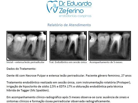 EQUIPE DE ENDODONTIA DE CAMPINAS Caso Clínico de Proservação do Tratamento Endodontico Dente