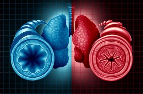 How Often Do Adults With Severe Asthma Switch Or Discontinue Biologics