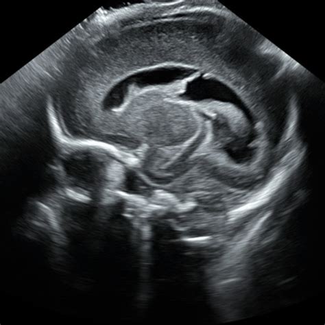 Neonatal Ultrasound Neurosonography Clinical Ultrasound Training