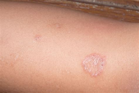 Is It Ringworm Signs And Symptoms