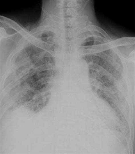 Chest Radiograph Showing Extensive Interstitial Infiltration Compared