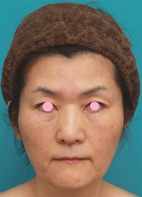 先日アップした、50代後半女性のたるんだ顔に脂肪溶解注射を行って小顔にした症例写真の解説です。 美容整形高須クリニック 高須 幹弥 オフィシャルブログ