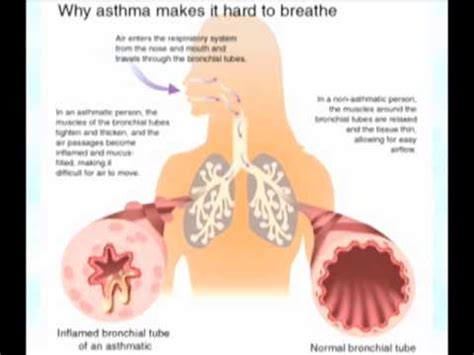 We did not find results for: How Does an Inhaler Prevent an Asthma Attack? - YouTube