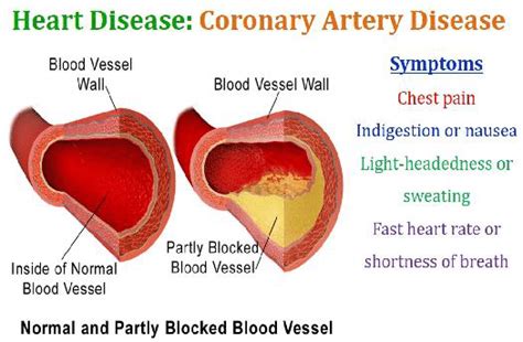 Free artery vein diagram templates. Coronary artery disease. | Download Scientific Diagram