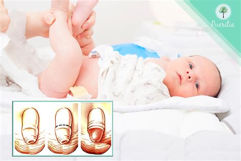 Sintomas De Fimose Infantil