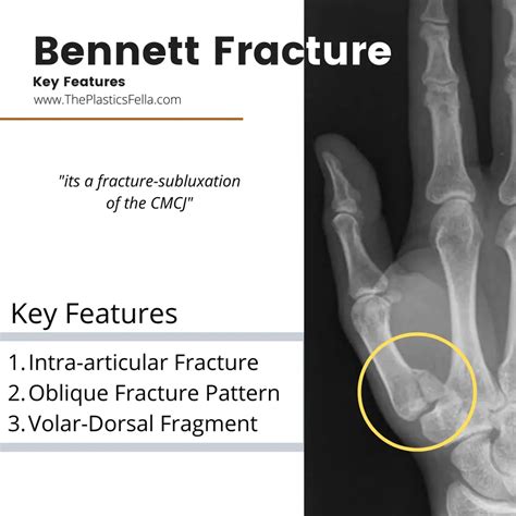 Bennett Fracture X Rays Diagnosis Treatment