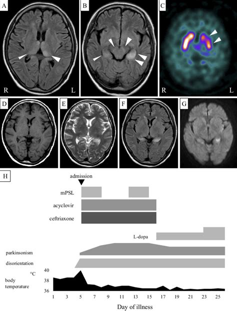 A B Brain Mri Flair Images Showing High Intensity Bilateral Lesions