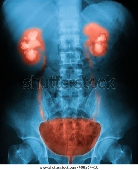 Xray Image Plain Kub Kidney Ureter Stock Photo Edit Now 408564418