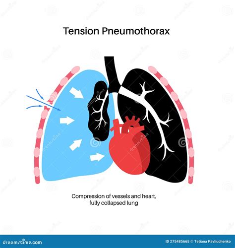 Tension Pneumothorax Poster Stock Vector Illustration Of Tissue