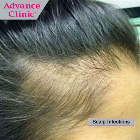 Yeast Infection On Scalp Hair Loss Causes And Treatment Martlabpro