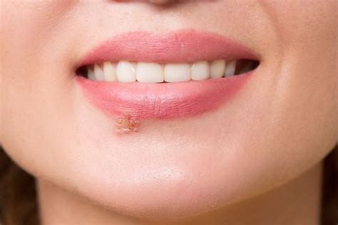 Blister On Lip Causes Treatment And Prevention