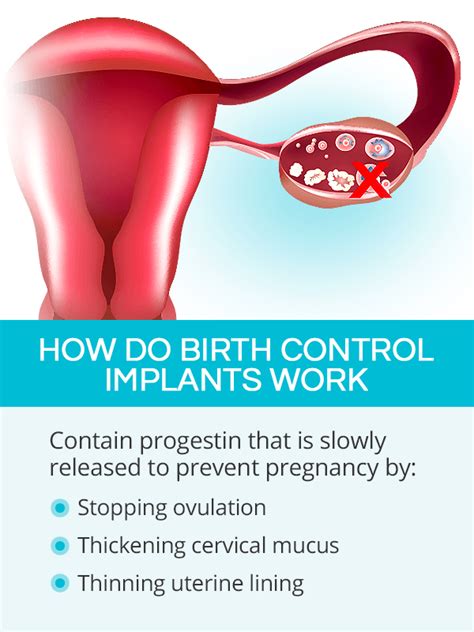Birth Control Implant Shecares