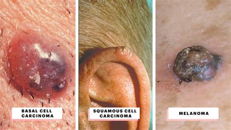 Swelling or a sore that does not heal; What Does Skin Cancer Look Like? A Visual Guide to Warning ...
