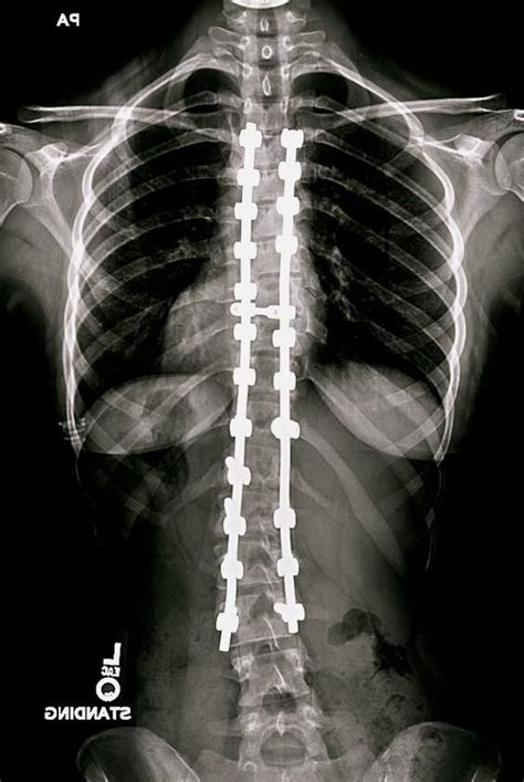 Spinal Fusion Surgeryxray Vision
