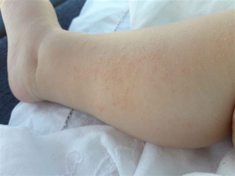 Chronic Spontaneous Urticaria An Expert Guide Useful For Doctor And