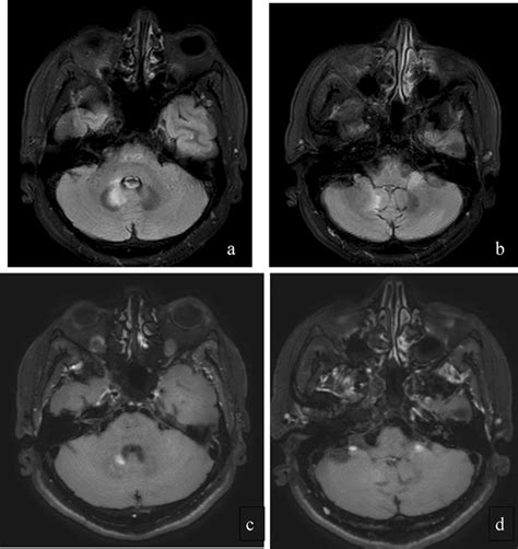 A B Cranial Mri Images Showing T2 Flair Hyperintense Lesions On Both