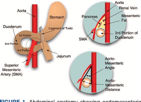 Table 1 From Superior Mesenteric Artery Syndrome Semantic Scholar