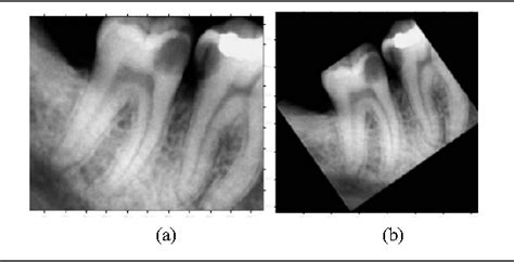 Figure 2 From Algorithm To Identify Enamel Caries And Interproximal